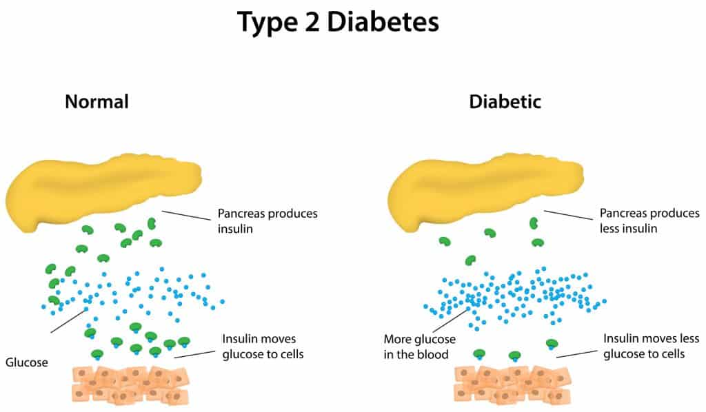 type 1 and type 2: a Type 2 diabetes graph showing the difference between a healthy pancreas process and a diabetic pancreas process.