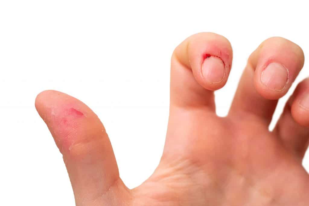 Chronic Skin Conditions